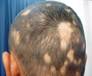 Saçkıran Mantarı Belirtileri ve Tedavisi