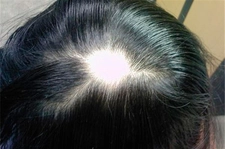 Saçkıran Belirtileri ve Tedavisi