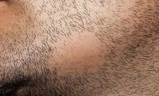 Yüzde Saçkıran Belirtileri ve Tedavisi