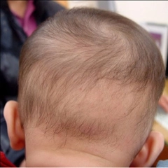 Bebeklerde Saçkıran Belirtileri ve Tedavisi