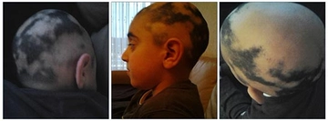 Dişi Saçkıran Belirtileri ve Tedavisi